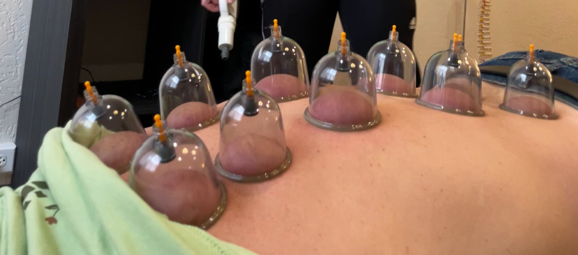 Image showing cupping therapy performed on an individual's spine